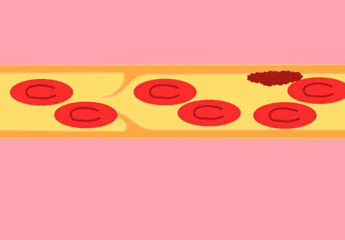 深靜脈血栓.gif